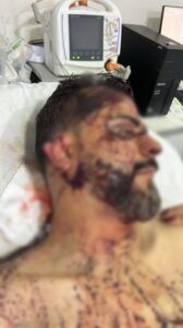 Imagem mostra vereador com parte da orelha decepada após ato criminoso em Rondonópolis